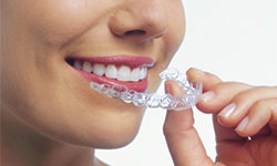 invisalign